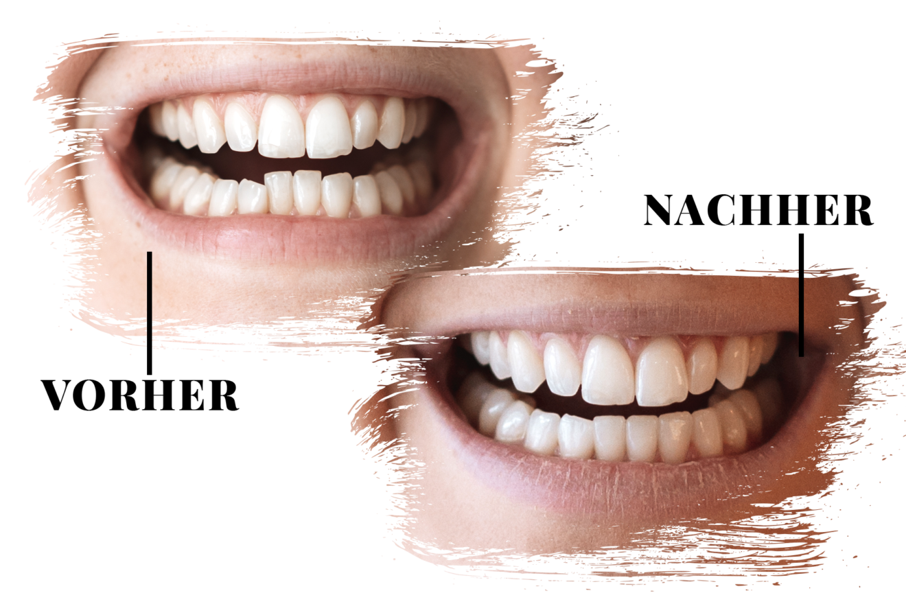 dr smile z�hne bleichen